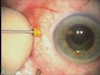 Trocar Insertion