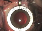 4 Steps to Astigmatism Correction During Cataract Surgery