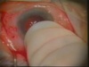 Suprachoroidal Hemorrhage