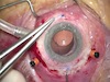 IOL Rescue via Sutureless Scleral Fixation