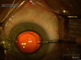 Exchanging a Multifocal IOL