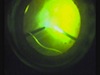 23G Cannula Drainage of Choroidals and Combined Phacovitrectomy in Retinal Detachment 
