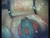 Artificial Iris Implantation