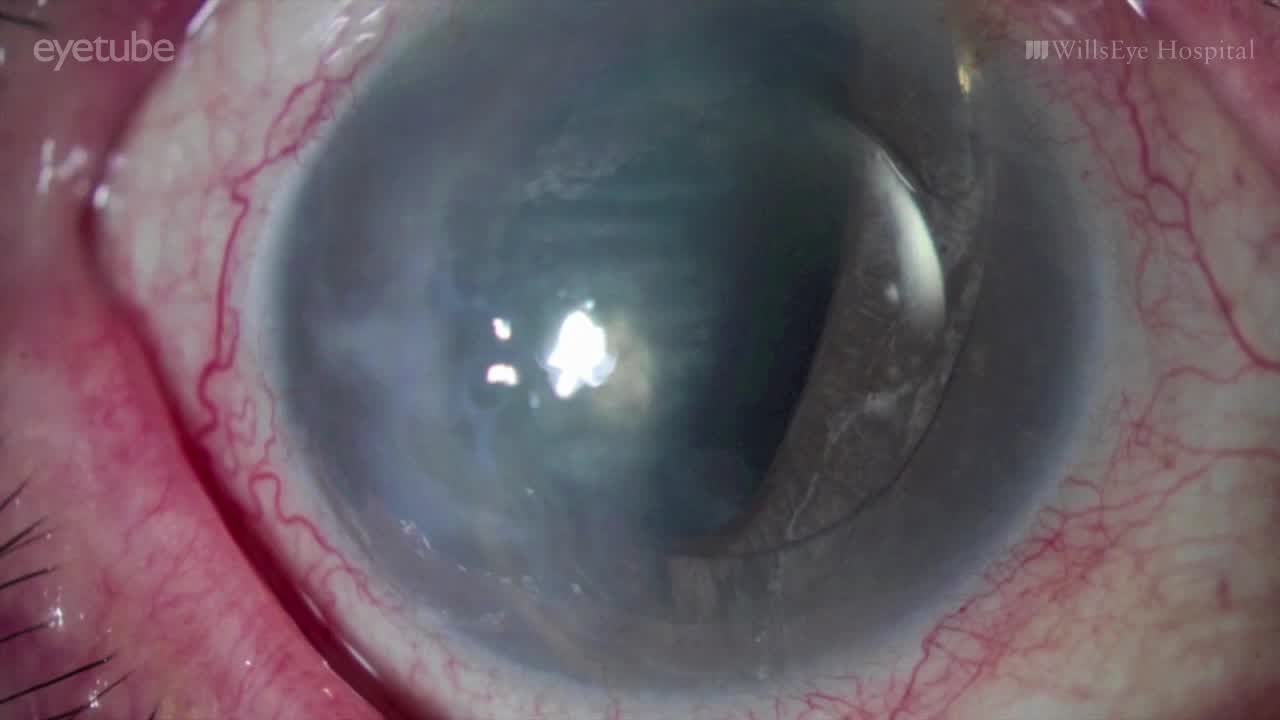Inside the Wills Eye OR: Complications With an ACIOL