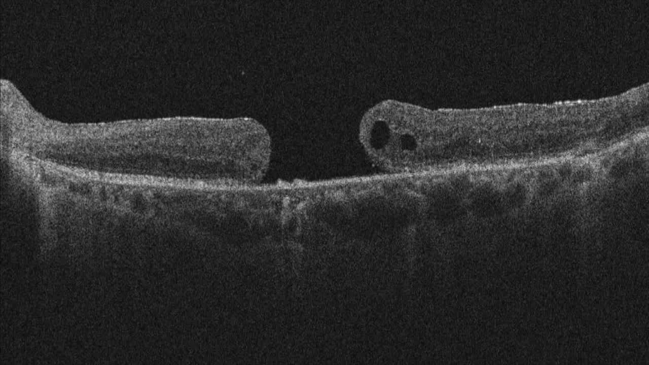 Repair of a Chronic Macular Hole