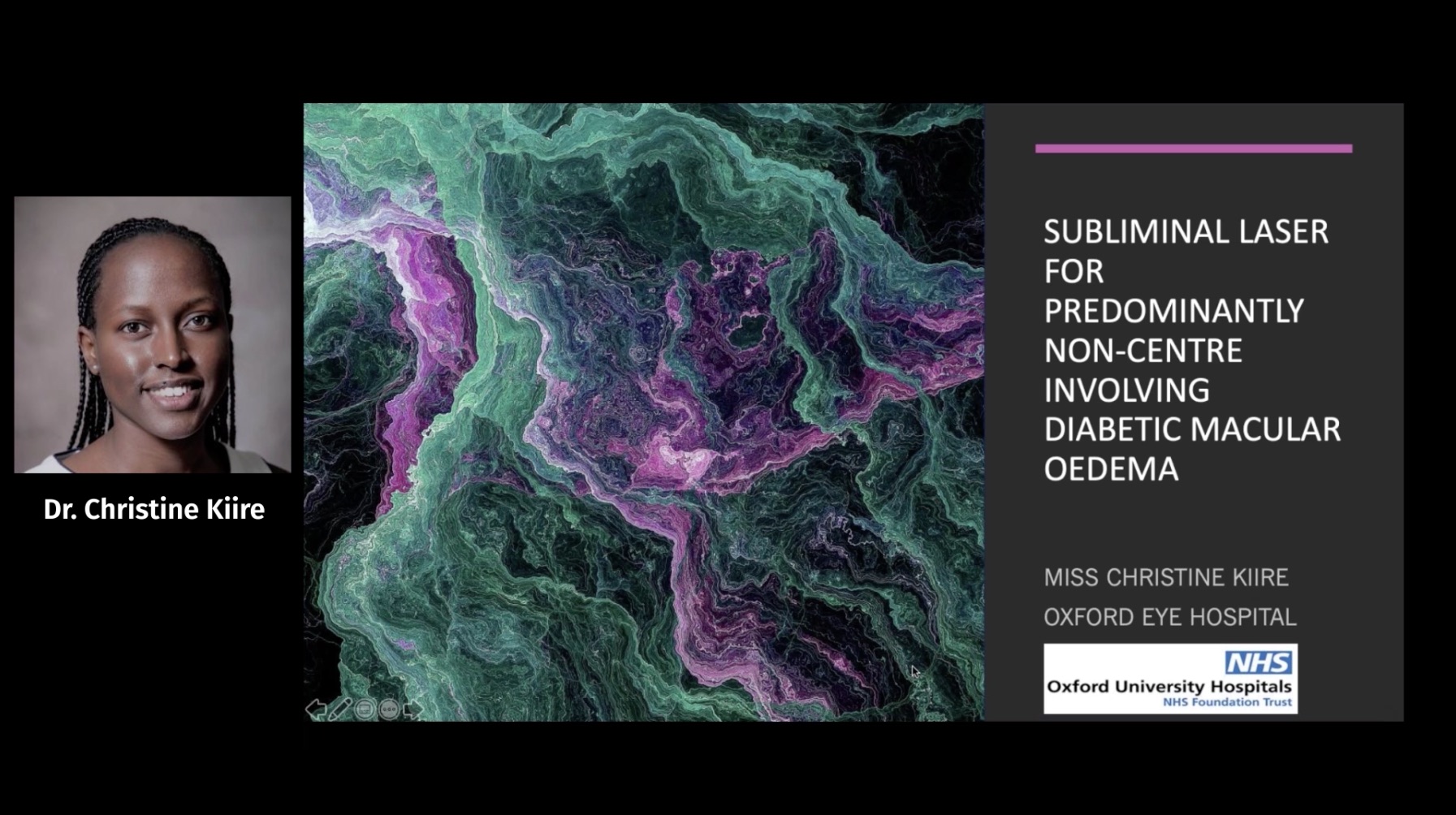 SubLiminal Laser for Predominantly Non-Center Involving DME?