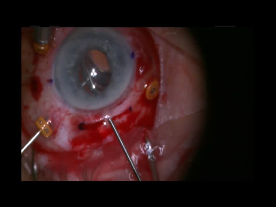 Novel IOL Fixation Using 4-0 Prolene
