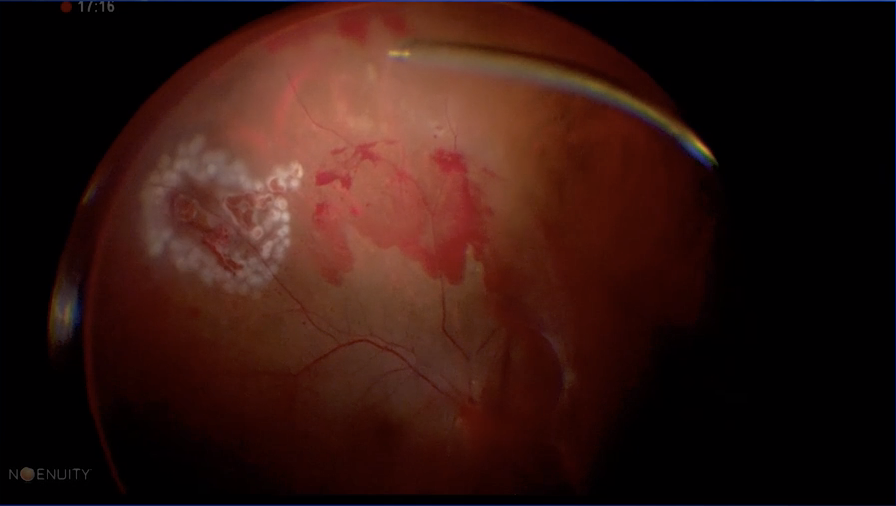 Diabetic Vitrectomy
