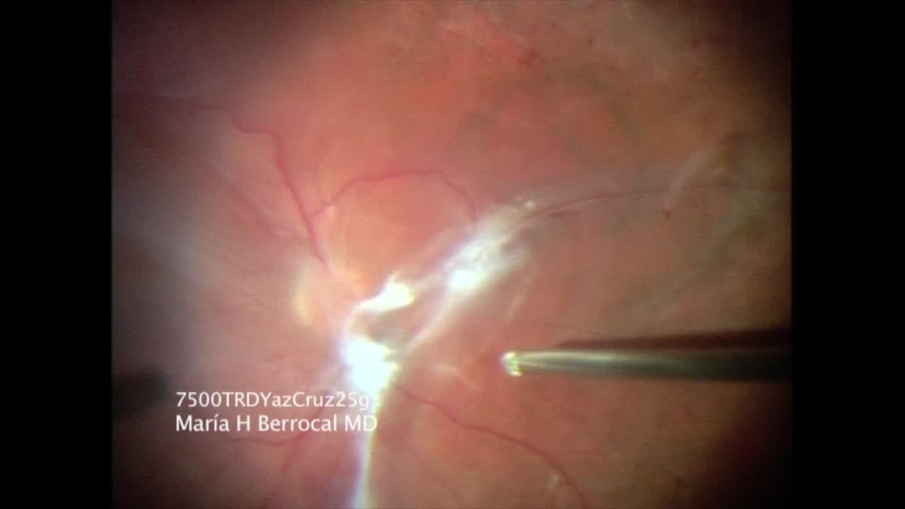 Back Cutting Technique for Detached Retina