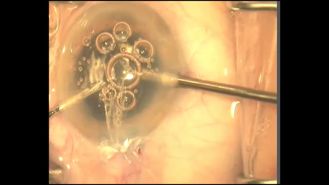 Explantation of Asymmetric Multifocal IOL Due to Calcification 