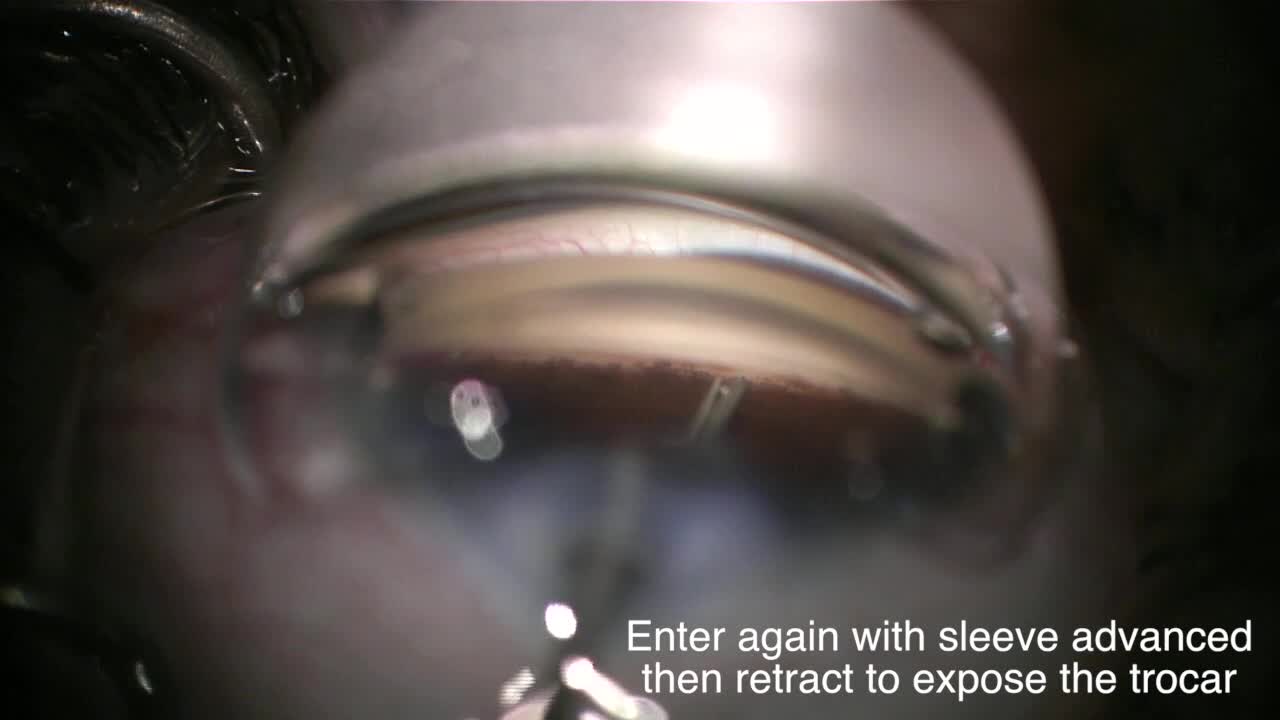 iStent inject First Day