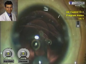 Managing Pediatric Traumatic Cataract with Torn Anterior Capsule