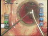 Hater MCTR Technique in Marfan Syndrome