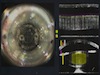 Cataract Removal without OVD