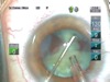 OZil IP to Extract a White Cataract