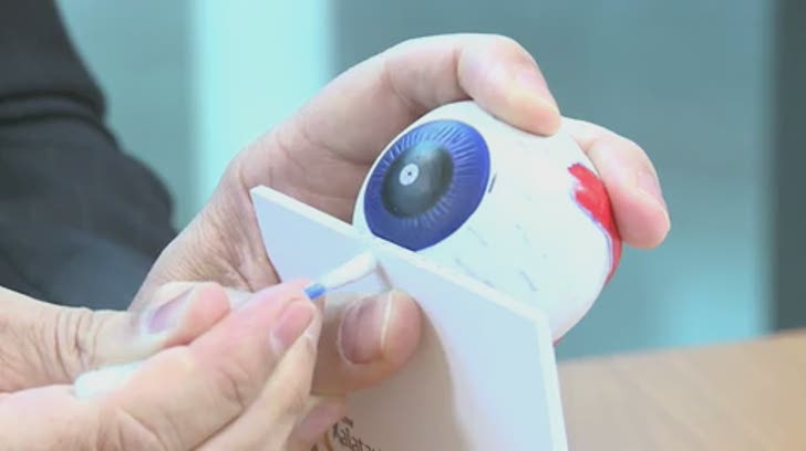 Meibomian Gland Expression