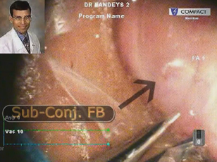 Surgical Pearls for Managing Pediatric Traumatic Cataract and Removal of Foreign Body