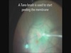 25-G Vitrectomy and Epiretinal Membrane Peeling Using Indocyanine Green ICG Dye