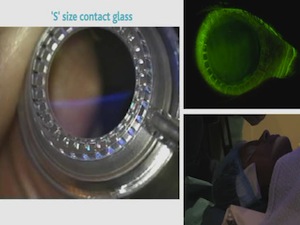 Real-Time ReLEx Smile Procedure Using the VisuMax Femtosecond Laser