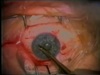Wire Retractor 