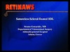 Sutureless Scleral Fixated IOL