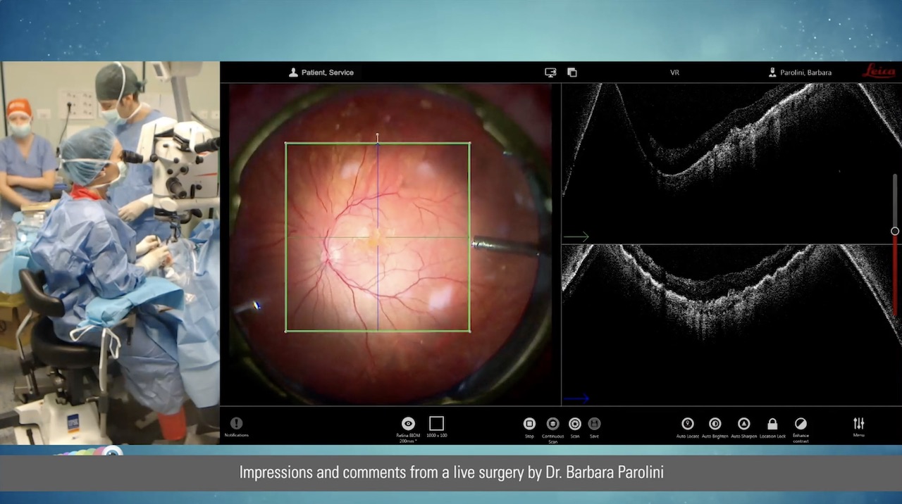 Scanning the Autologous Graft of Choroid Through the Eyes of the Intraoperative OCT