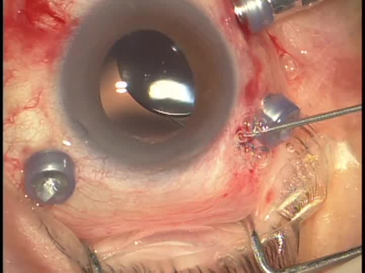27G needle Sutureless IOL Fixation with Scleral Pocket