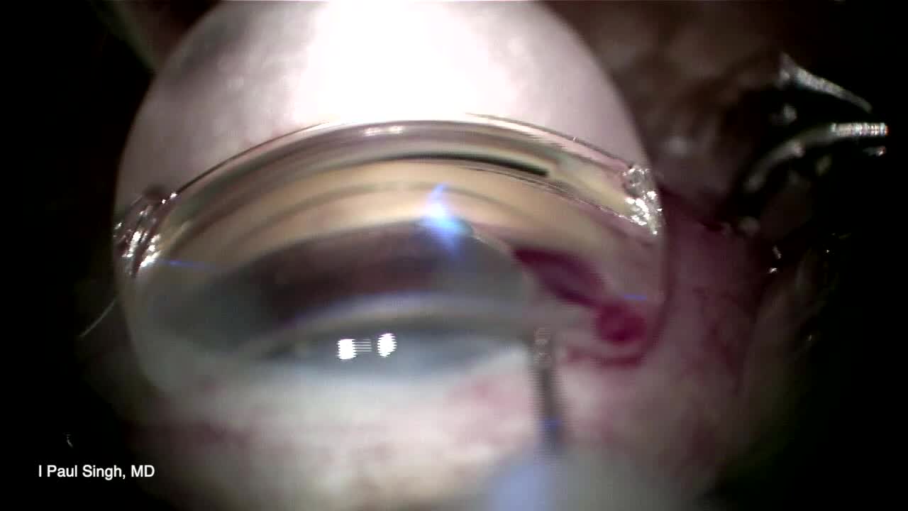 Viscodilation With Stenting: Maximizing Outflow