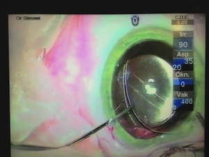 Implantation of Capsular Tension Ring
