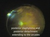 Retina Detachment Associated with Macular Hole in High Myopia