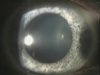 Complications of Phakic Lenses: Glaucoma