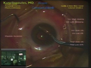 Retro-pupillary Artisan in Extreme, Myopic Aphake