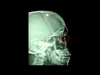 Removal of a Large Metallic IOFB in an Eye wth Good Vision