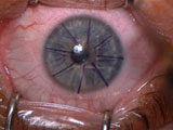 LASIK with Microkeratome and Femto laser