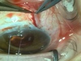Molteno3 230mm with Tutoplast Patch Graft - Part 1