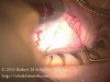 Transconjunctival Suturing Sclera
