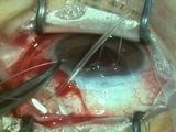 Molteno3 230mm with Tutoplast Patch Graft - Part 2