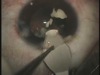 The World's Hardest Cataract
