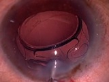 Removal of an Akreos IOL