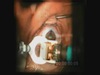 LASIK with Moria SBK