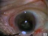 Anterior or posterior approach to nucleus recovery