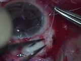 Repair Leaking Trabeculectomy