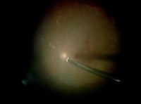 23G Vitrectomy After IOL Implantation