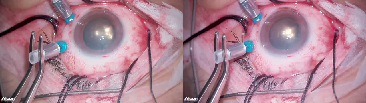 Vitrectomy Buckle ILM Peel (3D)