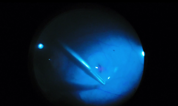 ILM Peel for Macular Hole Under Liquid PFC