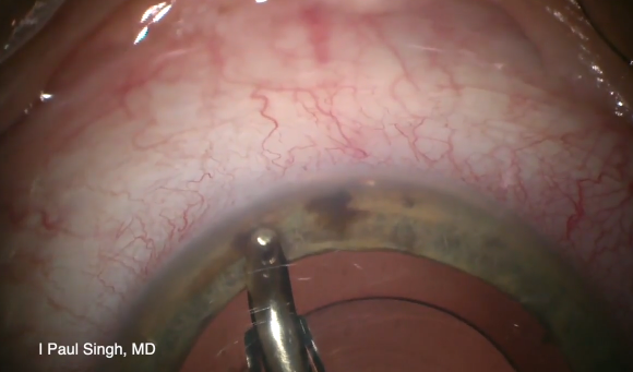 Combination Viscodilation Using the Omni Device and Hydrus Stent During Cataract Surgery