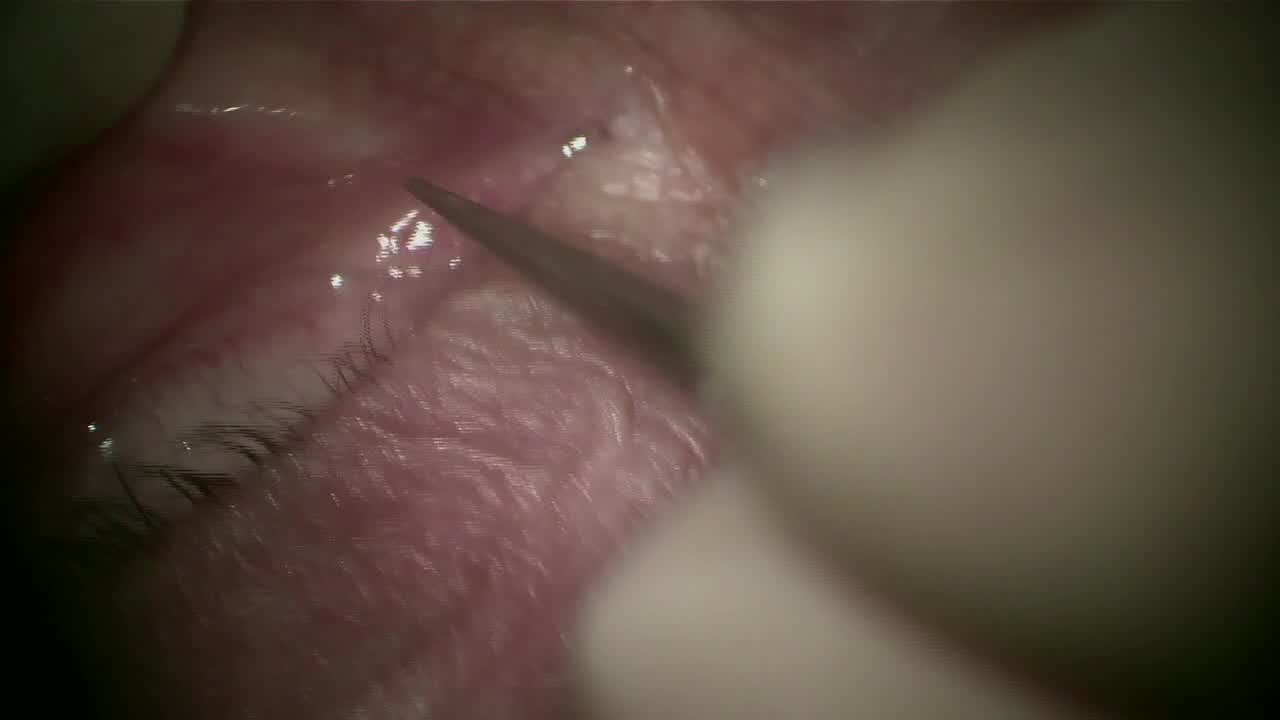Inserting Dextenza Through a Small Punctum