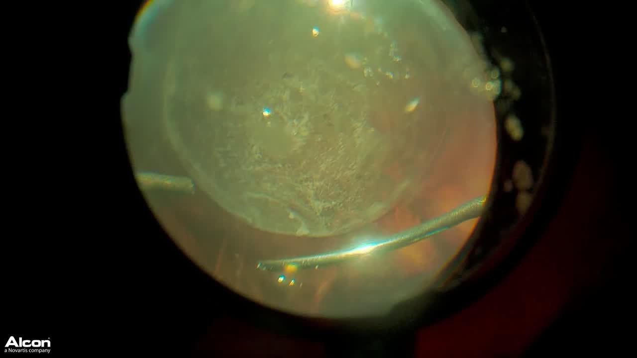 Retinal Detachment & Glaucoma