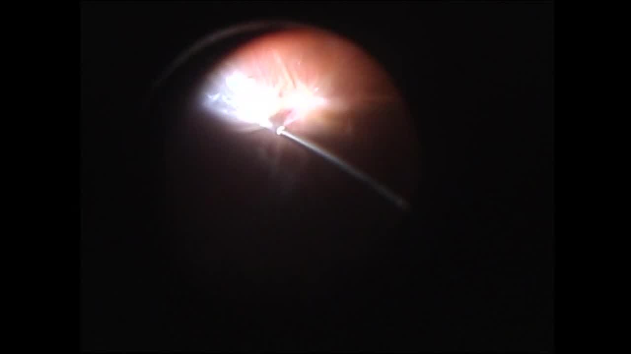 Diabetic Combined Retinal Detachment