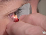 Indentation Gonioscopy